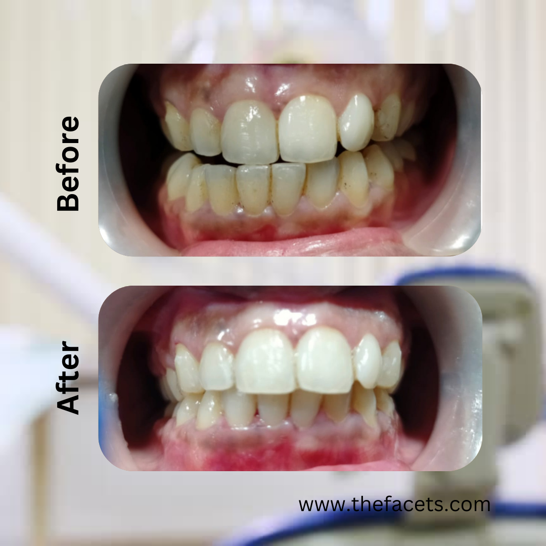 Before After Result 9